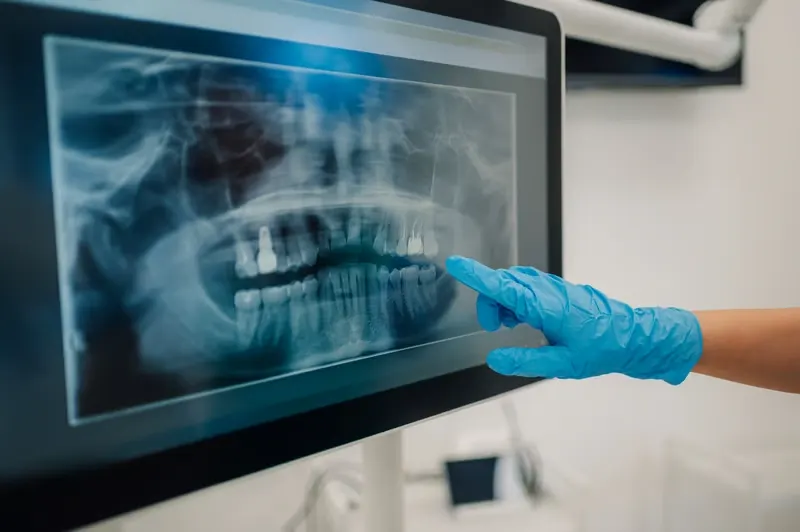 Dentysta analizuje pantomogram na ekranie cyfrowym w celu zaplanowania leczenia w Bel Sorriso w Helsingborg